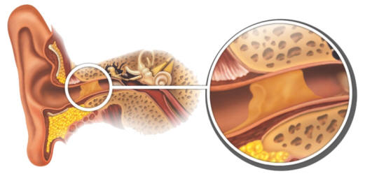 cerumen